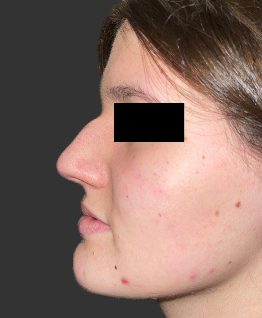 Prije — rinoplastika — operacija nosa